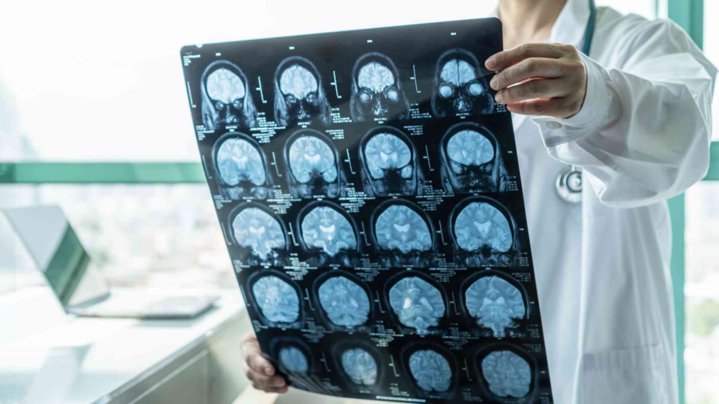 Brain disease diagnosis with medical doctor seeing Magnetic Resonance Imaging (MRI) film diagnose.
